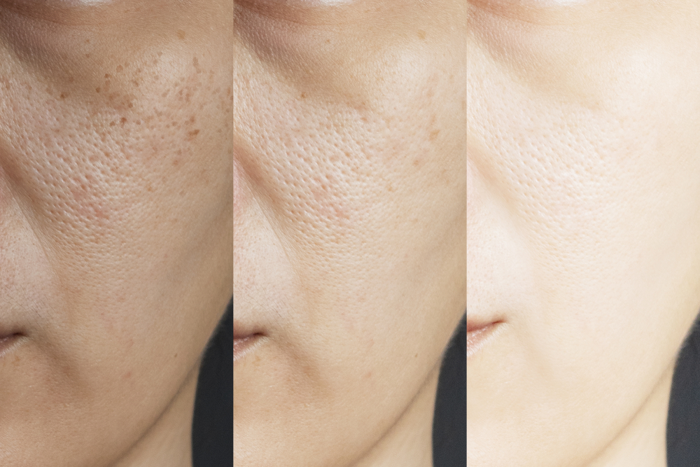 Glutathione Drips