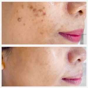 Before,And,After,Treatment,Of,Black,Spots,,Acne,Vulgaris,And