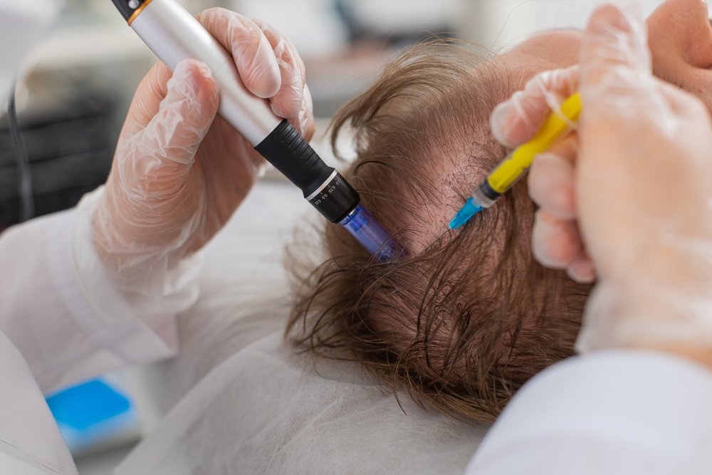 Alopecia.,Man,Hair,Loss,Improve,Growth,Treatment,Regeneration,,Dermapen,Microneedling,